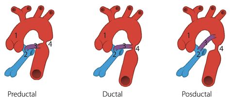 Técnicas de imagen en la coartación de aorta