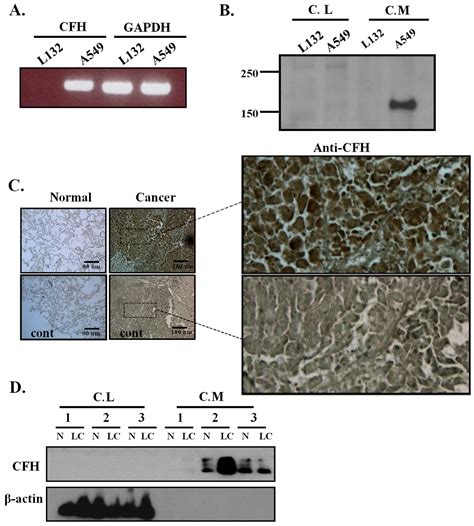 Upregulation of Complement Factor H by SOCS-1/3–STAT4 in Lung Cancer