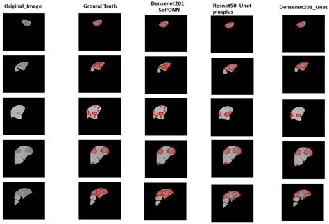 A Comparative Study of Decoders for Liver and Tumor Segmentation Using ...