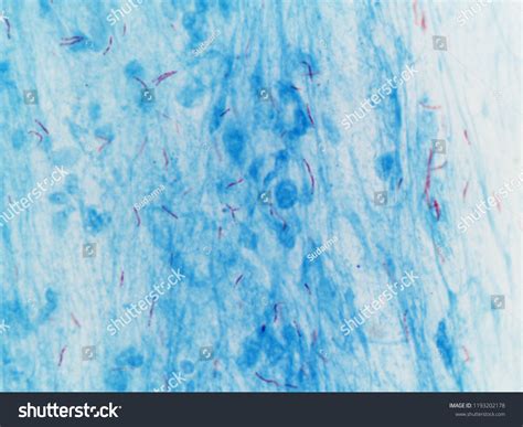 24 Ziehl-neelsen stain Gambar, Foto Stok & Vektor | Shutterstock