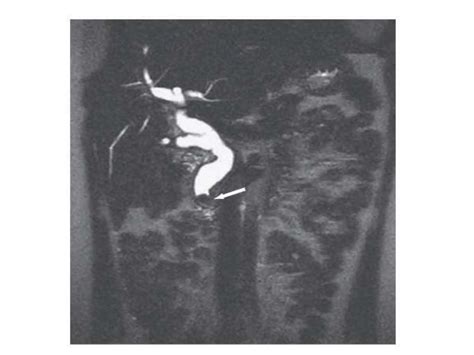 Endocopic, open and laparoscopic management of common bile duct stones.pptx