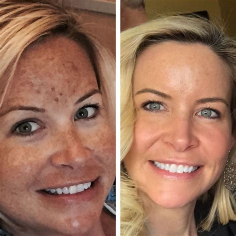 Trichloroacetic Acid 15% TCA Chemical Skin Peel for Fine | Etsy