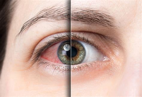 What is Dry Eye Syndrome?