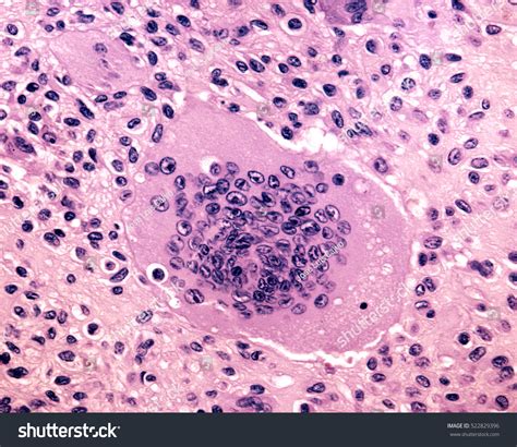 670 Bone tumour 图片、库存照片和矢量图 | Shutterstock