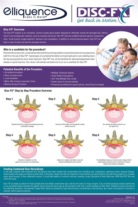 Image result for Disc FX Procedure
