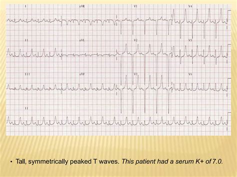 Diagnosis and management of Hyperkalemia | PPTX