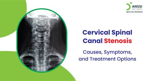 Cervical Spinal Stenosis Treatment