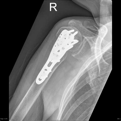 Anatomical Neck Of Humerus