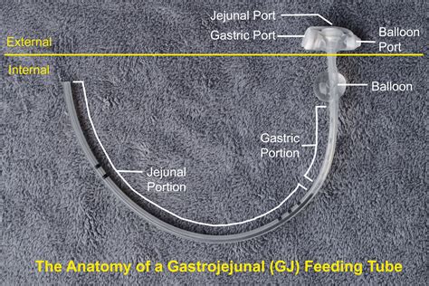 Oral Aversions and Feeding Tubes — The CDH Foundation