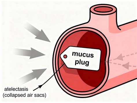 Mucus Plug in the Lungs: Causes, Symptoms, How to Clear