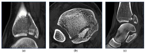 Fixation of Posterior Malleolus in Trimalleolar Ankle Fractures: Anteroposterior Screw or ...