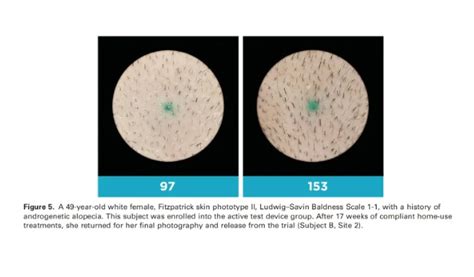Nyr Hairpro Pvt Ltd. : HairSmart India - Best Laser Caps for Thinning ...