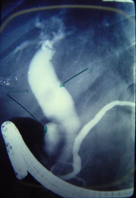 Biliary Stones 1569 Common Bile Duct Stones | Surgery Photos