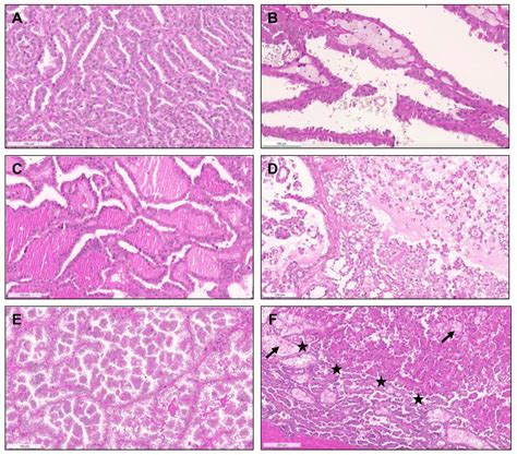 The Morphological Spectrum of Papillary Renal Cell Carcinoma and ...