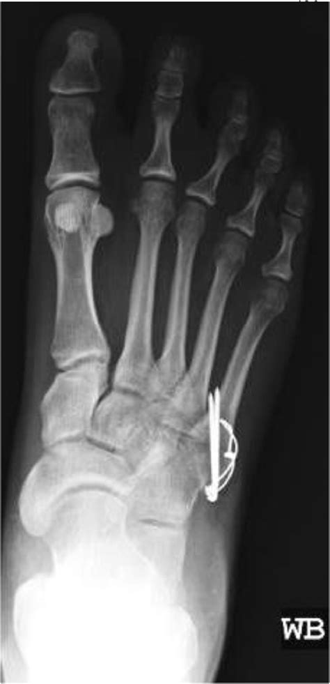 Conservative Versus Surgical Management of Fifth Metatarsal Avulsion Fractures - The Journal of ...