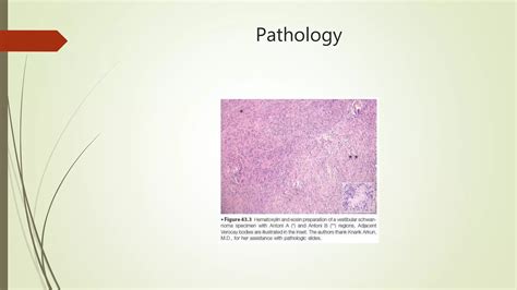 Cerebellopontine Angle Tumors | PPTX