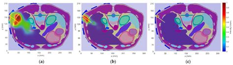 Microwave Catheter Navigation System for the Radiofrequency Liver Ablation