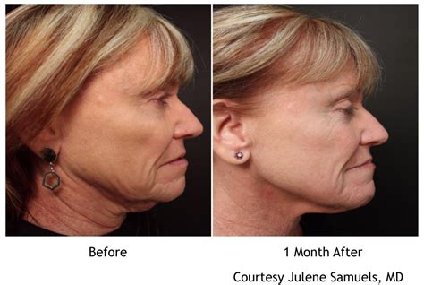 Image result for Profound Face Procedure