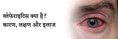 ब्लेफेराइटिस क्या है? कारण, लक्षण और इलाज | Blepharitis in Hindi