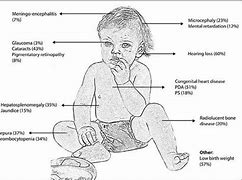 Image result for CRS 先天性风疹综合征(congenital rubella syndrome)