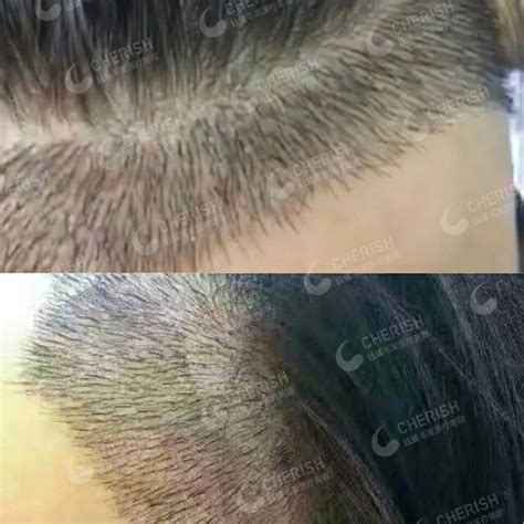 【盘点】FUT有痕头发种植和FUE微创植发技术哪里截然不同？_千颜网