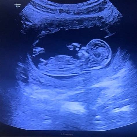 Nub theory 🤍 girl or boy? | BabyCenter