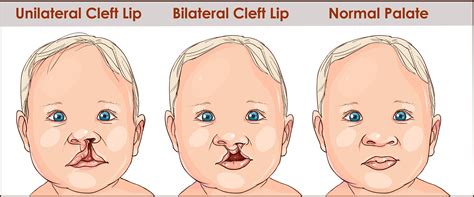Cleft Lip in Babies: Risks, Causes, and Prevention Tips
