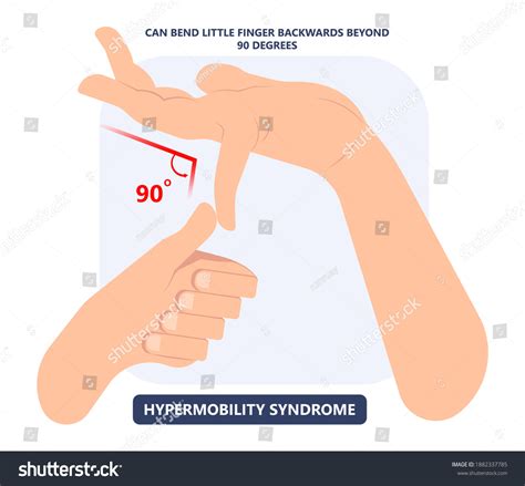 9 Elbow Hyperextension Images, Stock Photos & Vectors | Shutterstock