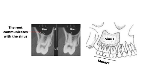Sinus Drainage Root Canal at Karen Medina blog