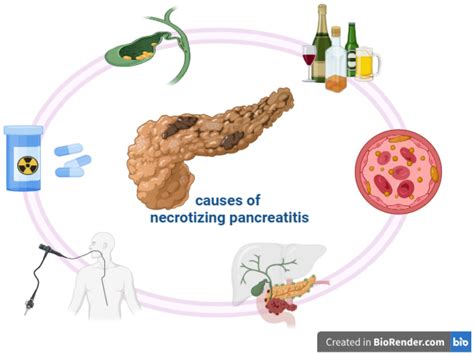 Necrotizing Pancreatitis Causes