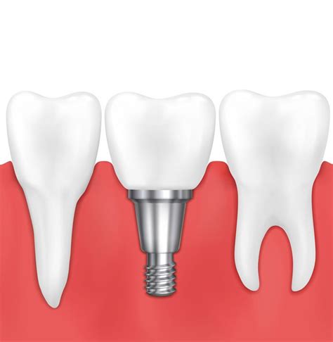 Image result for Different Types of Teeth Implants