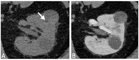 Minimal Fat Content in Papillary Renal Cell Carcinoma Diagnosed with Dual-Layer Dual-Energy CT