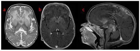 Leukodystrophy with Macrocephaly, Refractory Epilepsy, and Severe ...