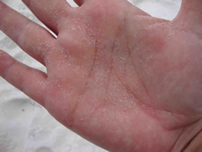 rash palms of hands - pictures, photos