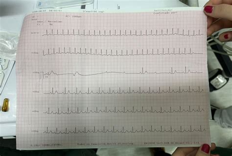 Adenosine Ekg Strip Images