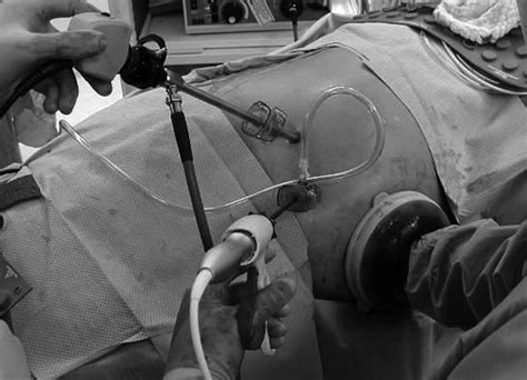 Image result for Hand-Assisted Nephrectomy