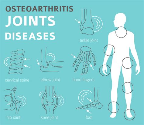 OSTEOARTHRITIS AND SSD BENEFITS - Cannon Disability Law
