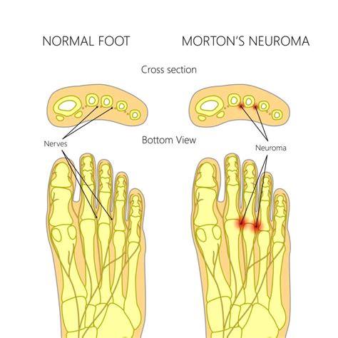 Blog 14 - Morton’s Neuroma: Causes, Symptoms, and Treatment