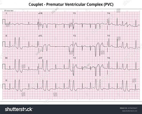 276 Premature Ventricular Images, Stock Photos & Vectors | Shutterstock