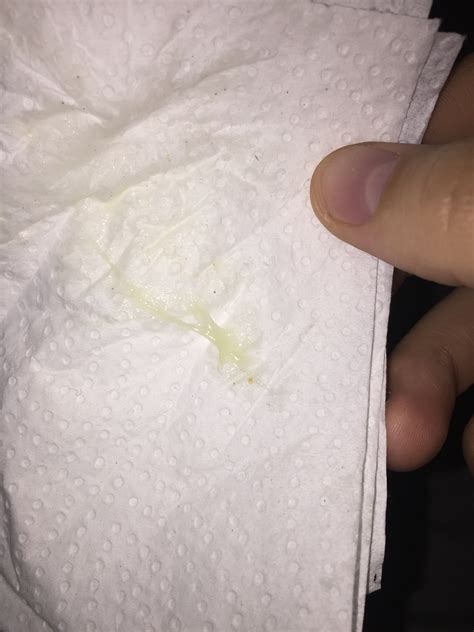 Occasional White Discharge Yellow Vaginal Discharge: Color,