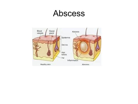 Abcess+incision+and+drainage | PPT