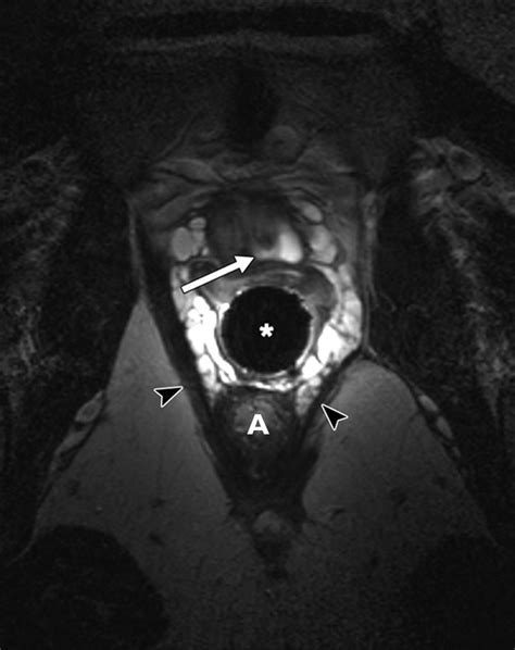 MRI Evaluation of Urethral Diverticula and Differential Diagnosis in Symptomatic Women | AJR