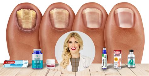 The best toenail fungus treatment for 2026, according to dermatologists Aesthetic