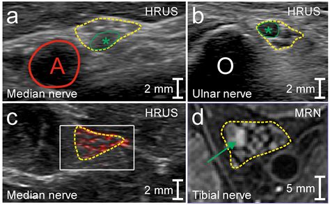 Peripheral Nerve Imaging Aids in the Diagnosis of Immune-Mediated ...