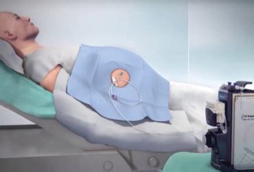 Image result for Paracentesis Procedure Kit