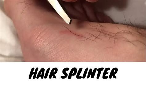 Image result for Hair Splinter Infection