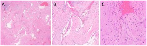 Extra-Axial Cavernous Angioma: A Case Report and Review of the Literature