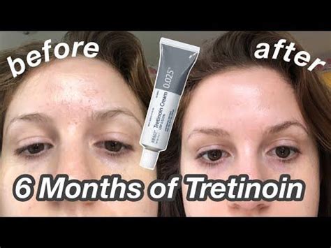 6 Month Tretinoin/Retin-A Update: Before & After + My Current Skincare ...