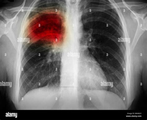 Lobar Pneumonia Chest Xray