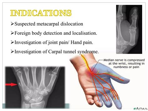 Projections of carpal tunnel and wrist | PPTX